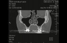 113 — MRI of my own Head being Strata Cut
